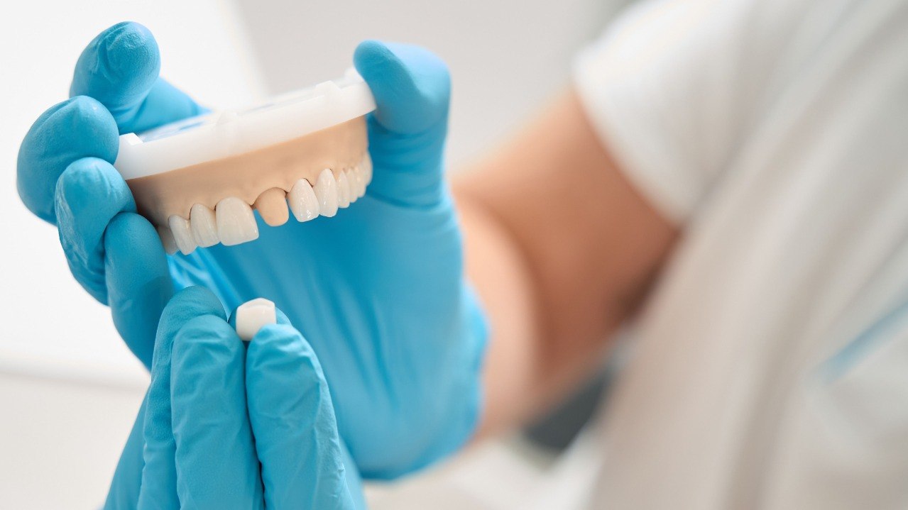 Faccette dentali a Roma: cosa sono e quando sceglierle