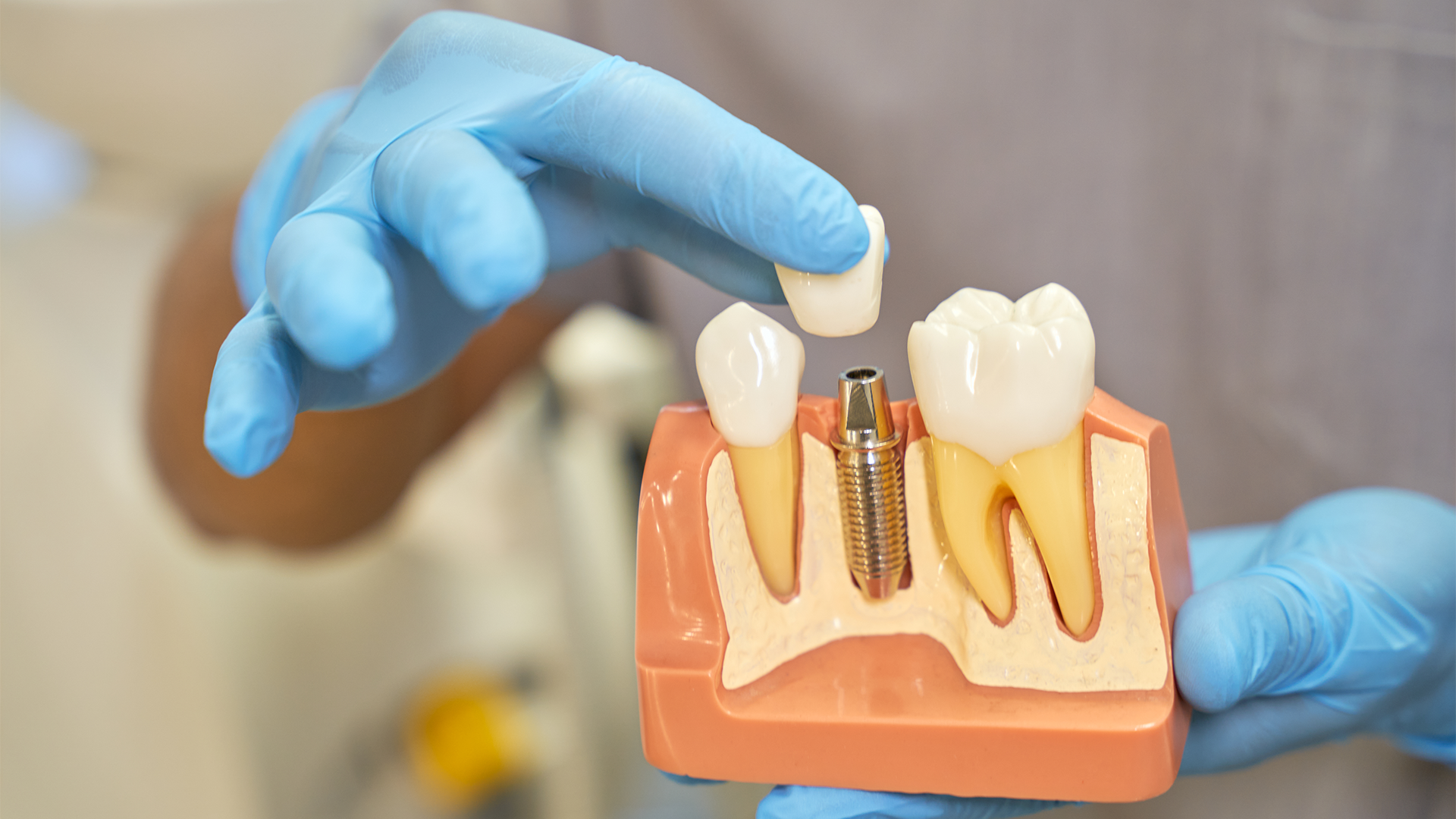 Impianti dentali a Roma: come funzionano e quando sceglierli