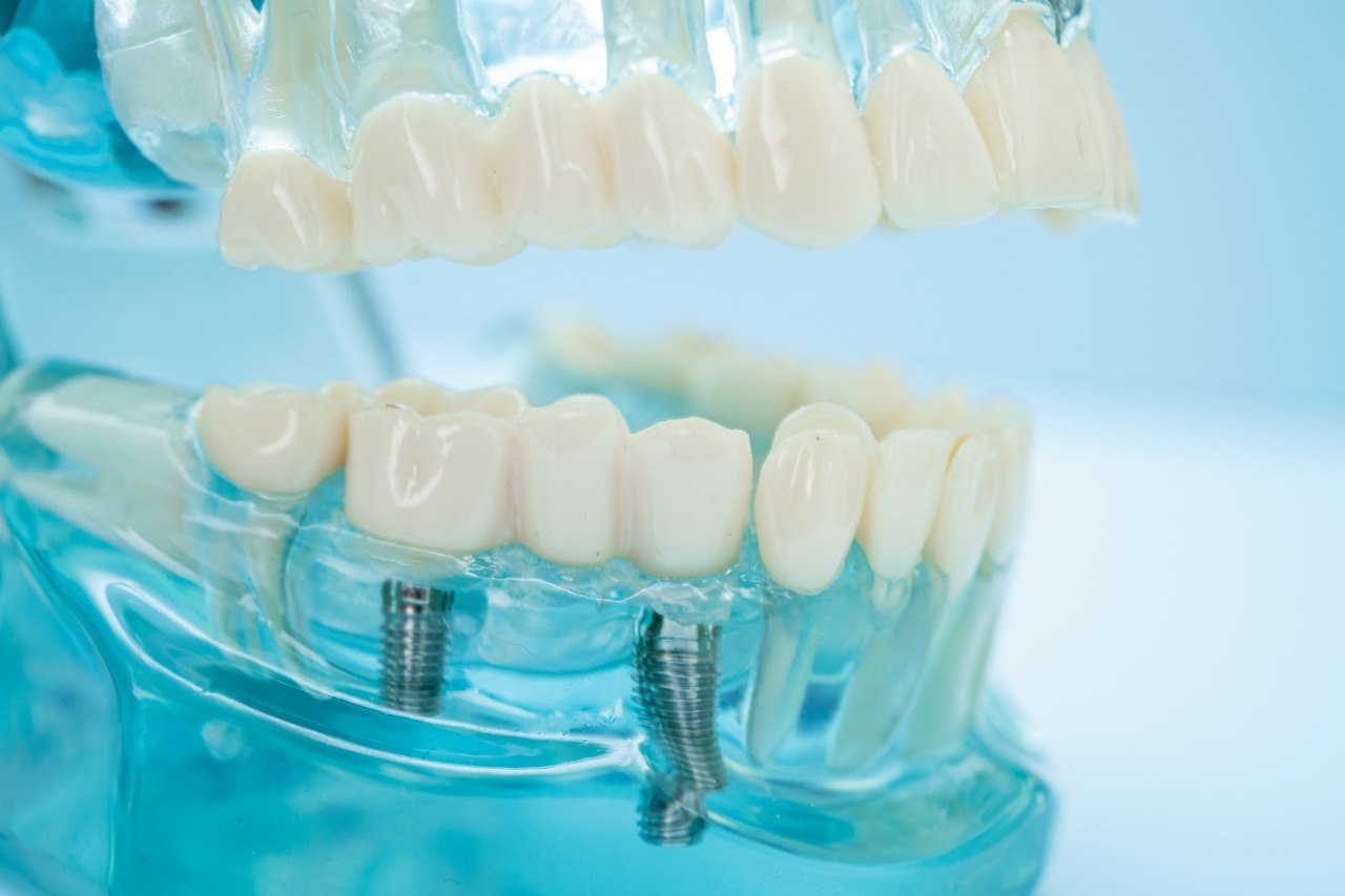 Paura dell’impianto dentale: separiamo i fatti da quello che si teme